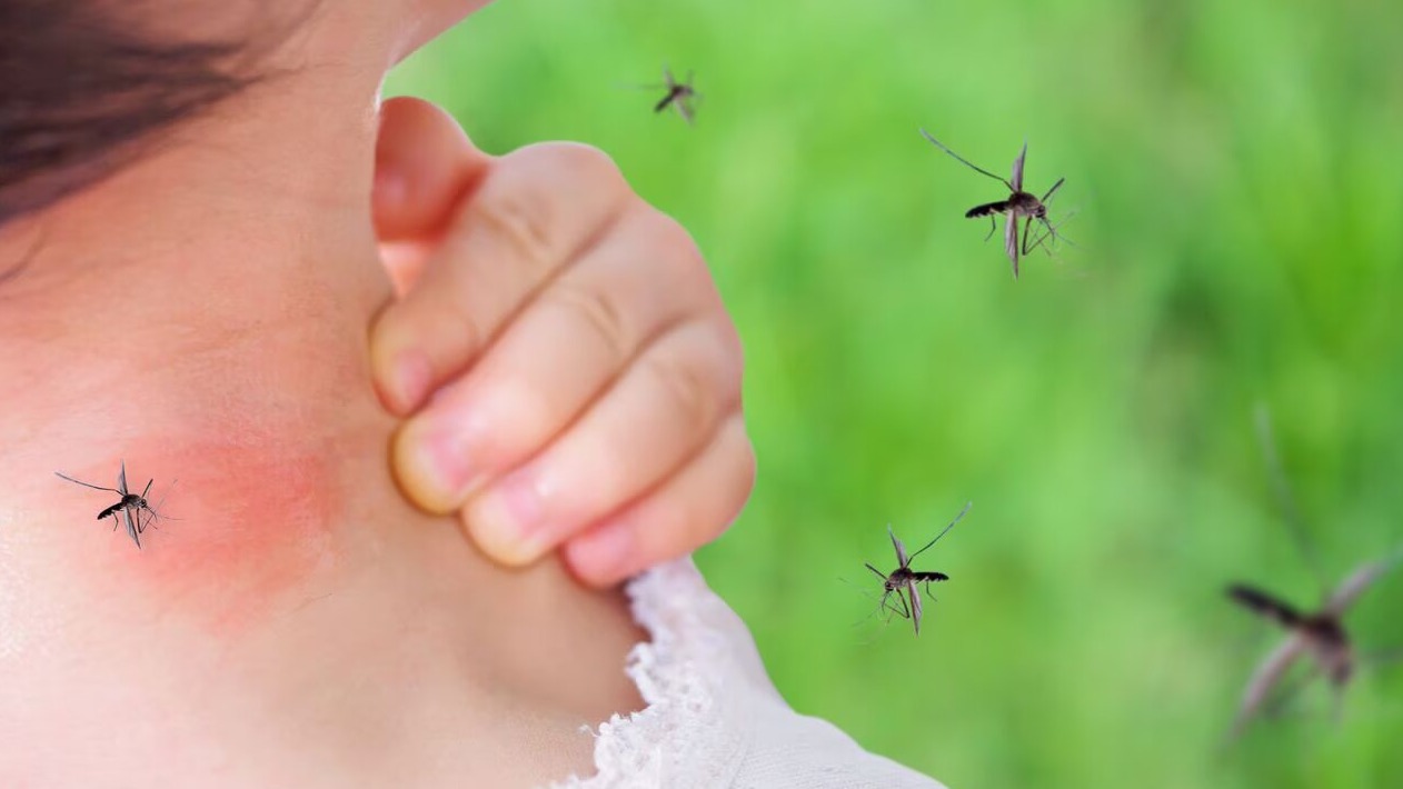 ¿Cómo aliviar las picaduras de mosquitos? Prueba con estos remedios domésticos