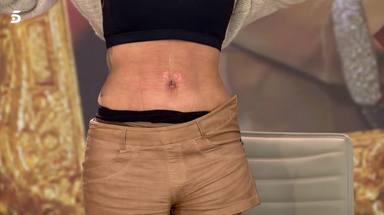 El nuevo abdomen de Marta López tras pasar por quirófano