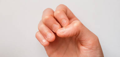 Los signos de que morderte las uñas te causa un daño muy importante en las manos y dientes